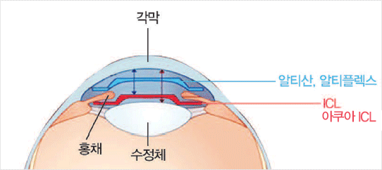 안내렌즈 삽입 위치에 따른 렌즈의 구분